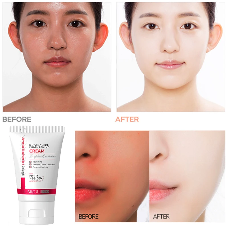 Whitening Freckle Cream Melasma Pigmentation Remove Nicotinamide Serum Cream Pores Refining Black Spot Acne Marks Removal Cream