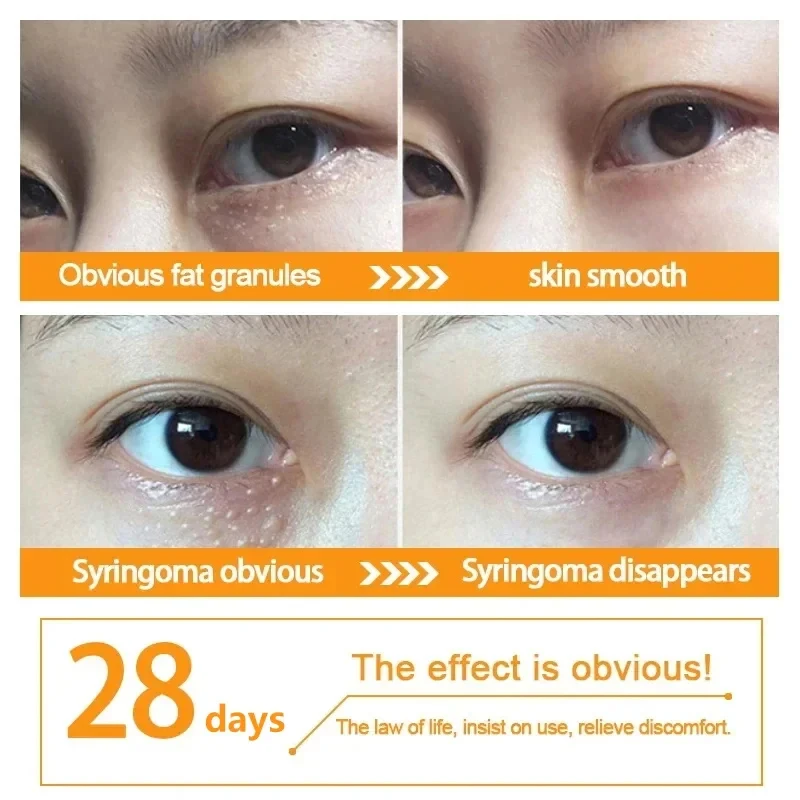 Fat Granules Remover Eye Cream Anti-Puffiness Anti Inflammatory Reduce Dark Circles Fade Fine Lines Repair Barrier Firm Cream