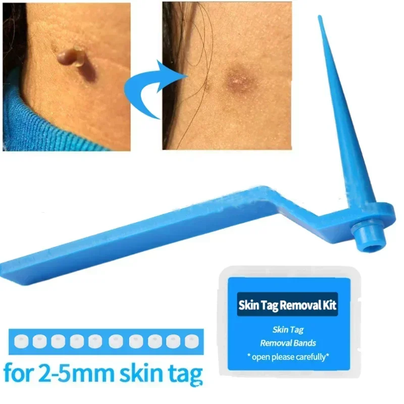 1 Set Skin Tag Removal Kit Skin Mole Wart Remover Micro Band Skin Tag Removal Kit Tag Treatment Tools Set with Cleansing Swabs