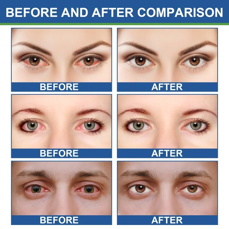 Crema para Ojos que promueve una vista más clara, masaje relajante suave, reduce la incomodidad, alivia la fatiga de los ojos secos, cuidado de la salud ocular