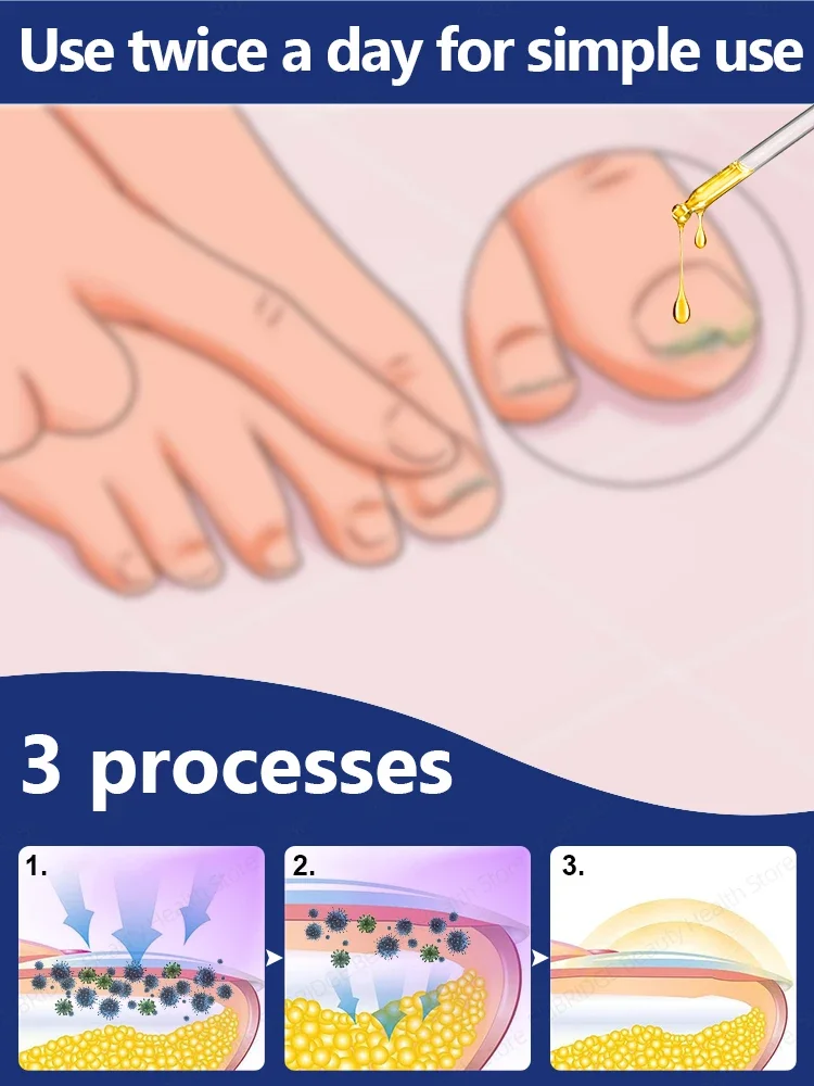Quickly eliminate fungus and restore healthy nails