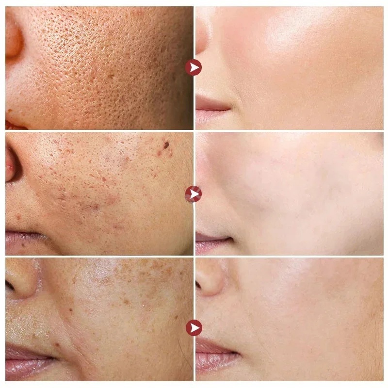 Salicylic Acid Pore Shrinking Cream Reduce Large Pore Tighten Refining Face Repair Rough Dull Pore Brighten Moisturize Skin Care