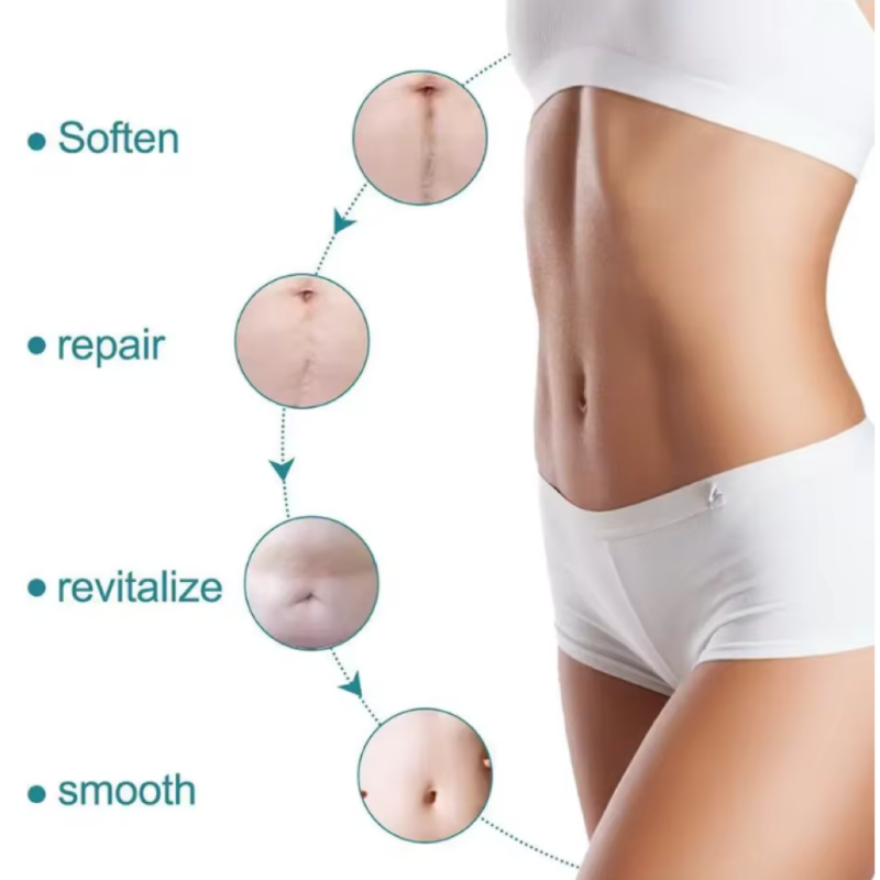 4cmx150cm Silicone Scar Sheets Removal Strips Silicone Gel Scar Strip For Acne Keloid Surgery Burn Treatment Scar Patch Hot Sale