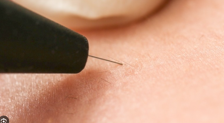 Máquina de electrólisis no invasiva para el hogar, avanzada, depilación blanca, suministros de belleza en línea