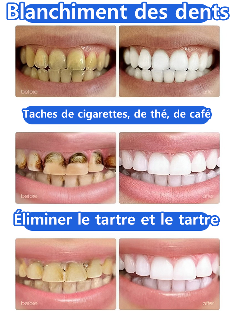 Blanchiment des dents, restauration rapide et naturelle des gencives, avis utilisateurs extrêmement positifs
