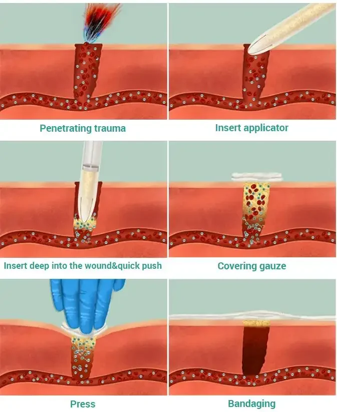 Aplicador de pó de quitosana 6g com bandagem de grânulos hemostáticos rápidos, cuidados médicos para emergência tática, uso externo, kit de sobrevivência