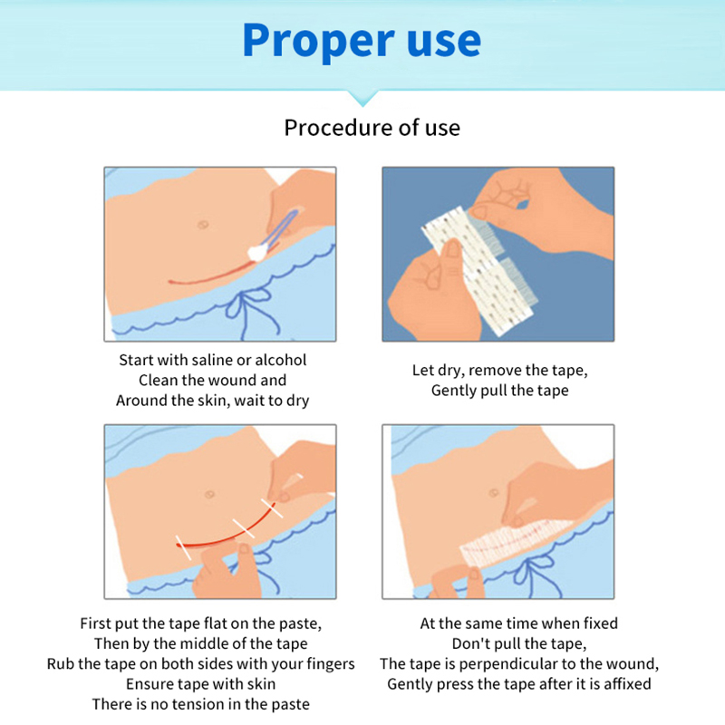 Steriele Strip EHBO Reiswond Huidsluitingen Medische Chirurgische Lijm