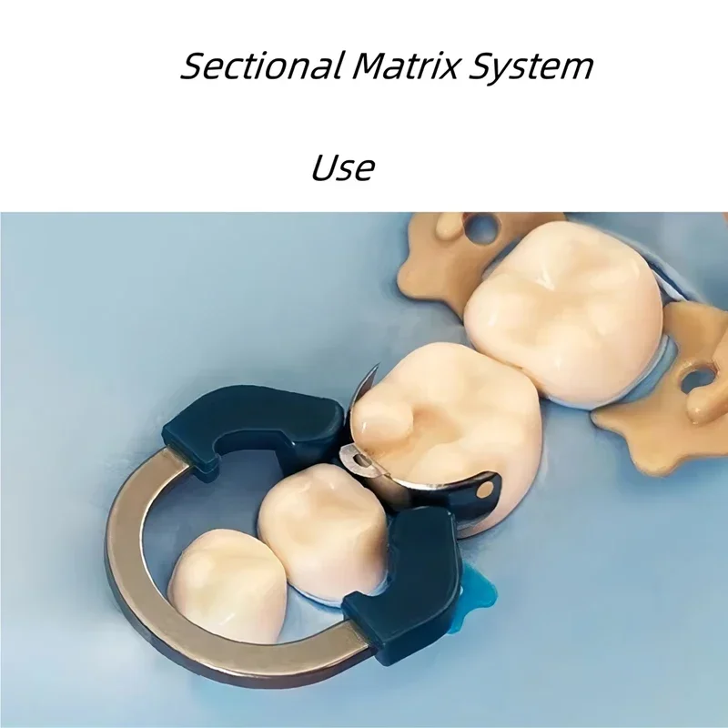 Dental Matrix Bands NITI โลหะเมทริกซ์ Clamp แหวนตัดโค้ง Matrix ระบบนิกเกิลไทเทเนียม Clamping แหวนเครื่องมือทันตแพทย์