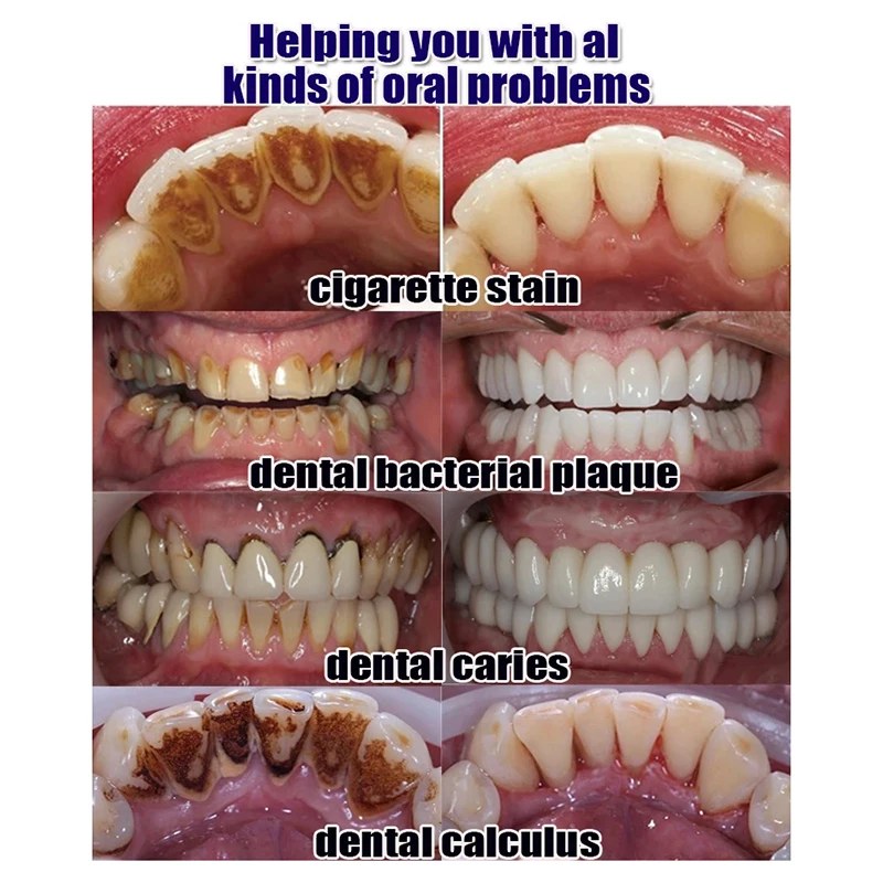 Dissolvant de Tartre Dentaire, Blanchiment des Dents, Élimination des Odeurs Buccales, Plaque SAP, Agents de Blanchiment, MAXde la Parodontite, Soins Buccaux