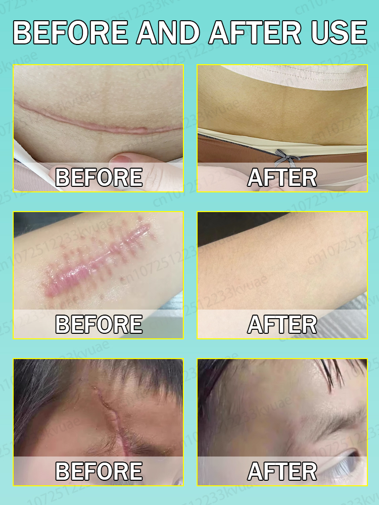 Crema para eliminar cicatrices. Elimina eficazmente las cicatrices de heridas y repara las cicatrices.