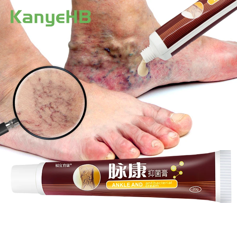 1 Chiếc Suy Giãn Tĩnh Mạch Điều Trị Kem Loại Bỏ Hồng Vệt Giãn Tĩnh Mạch Thừng Tinh Viêm Mạch Phlebitis Tăng Cường Mao Mạch Sức Khỏe S034
