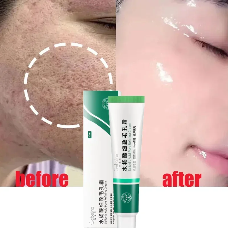 Crema reductora de poros con ácido salicílico, eliminación rápida de poros grandes, eliminación de puntos negros, estiramiento facial, reparación suave, productos para el cuidado de la piel