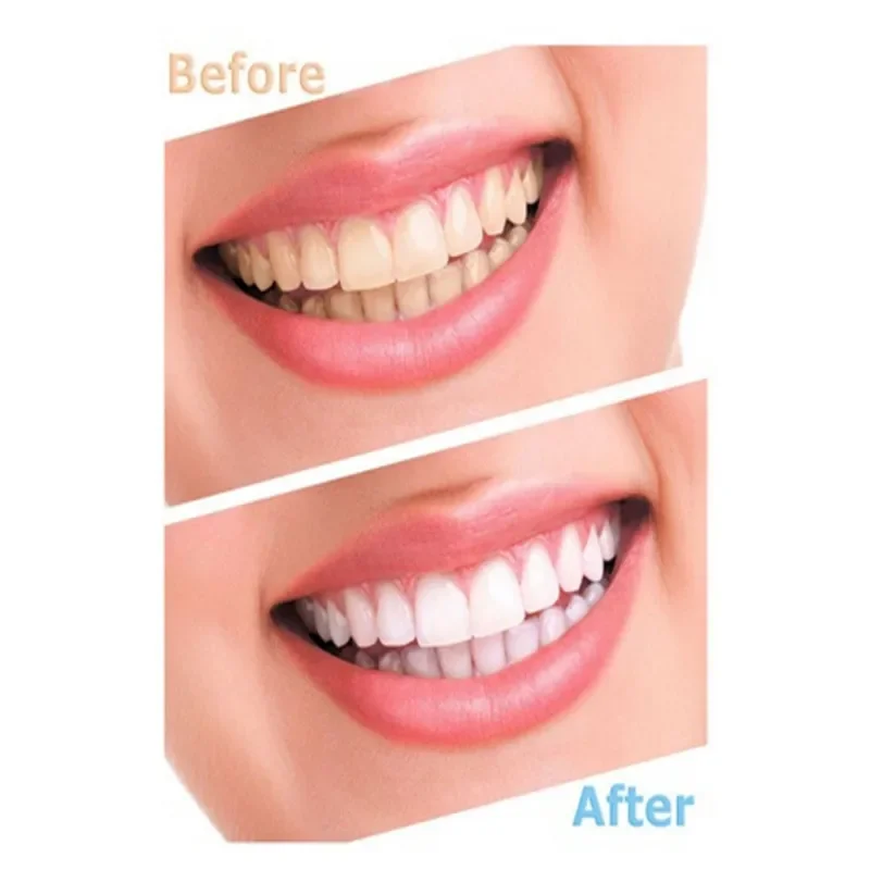 Protector nocturno Dental transparente para rechinar los dientes, bruxismo, protección del sueño, bandejas para la boca superior e inferior, blanqueamiento, 2 uds.