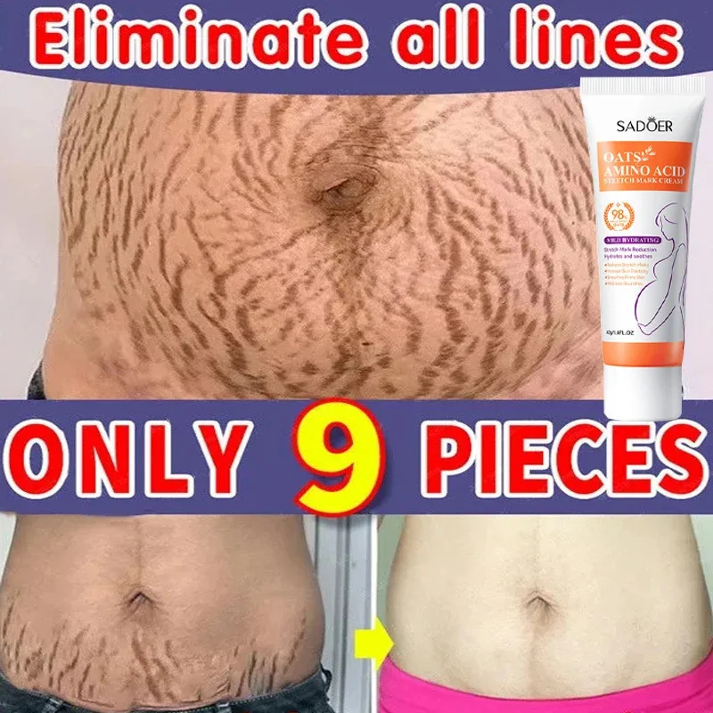 Crema de eliminación permanente de estrías, elimina las estrías del cuerpo y el vientre, estrías de hinchazón, elimina las grietas de la piel, repara el cuidado reafirmante