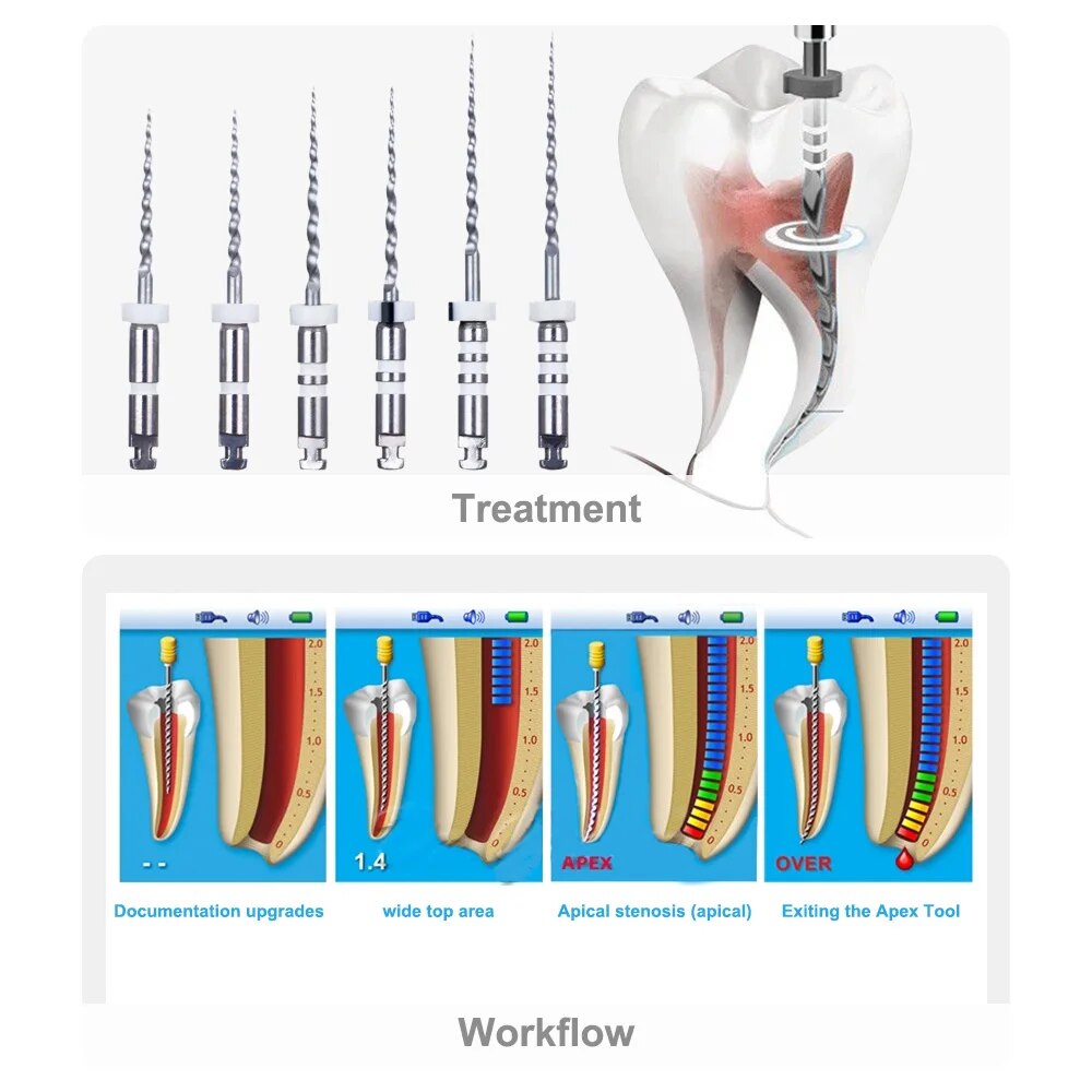 6 unids/caja motor de retratamiento Dental Canal radicular NiTi archivo Denspay D1-D3 NiTi Super D limas rotativas para herramientas de limpieza de conducto radicular