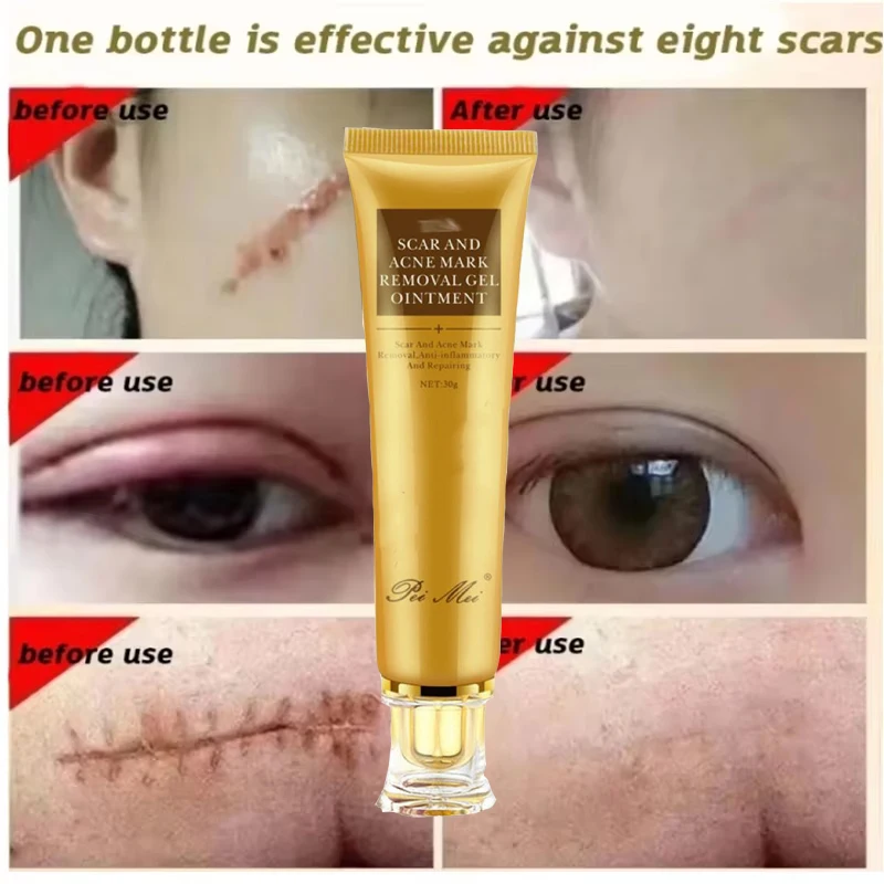 Crema de eliminación rápida de cicatrices, tratamiento efectivo, estrías, quemaduras, cicatrices quirúrgicas, reparación de manchas de acné, blanqueamiento, hidrata, cuidado de la piel a base de hierbas