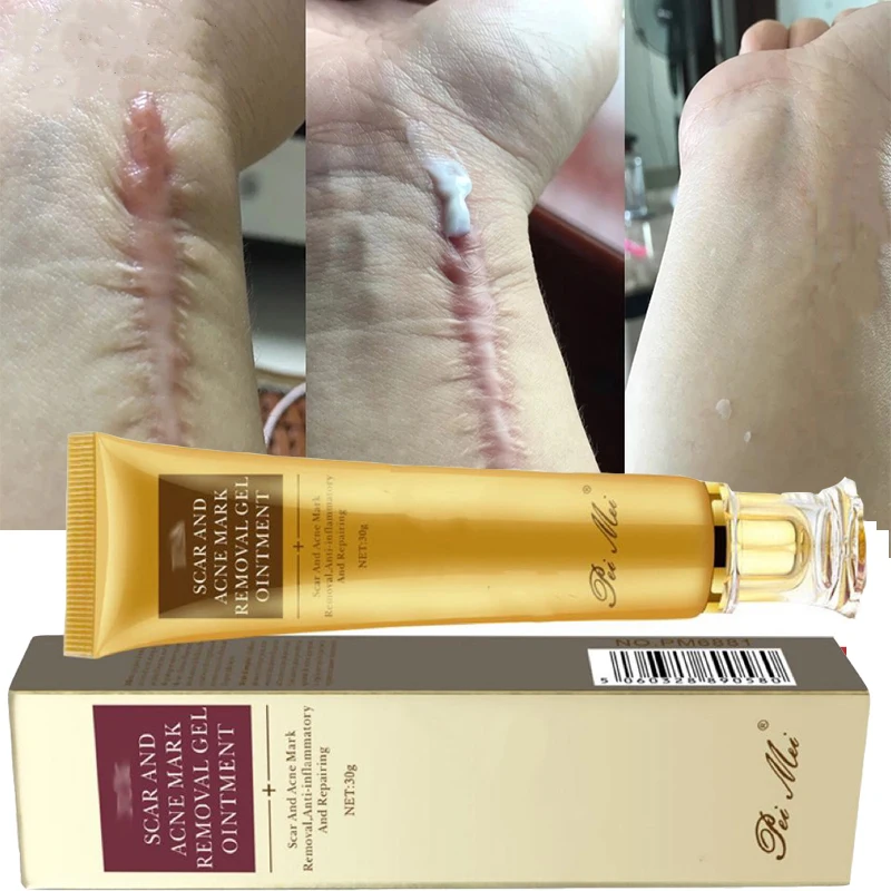 Crema de eliminación rápida de cicatrices, tratamiento efectivo, estrías, quemaduras, cicatrices quirúrgicas, reparación de manchas de acné, blanqueamiento, hidrata, cuidado de la piel a base de hierbas