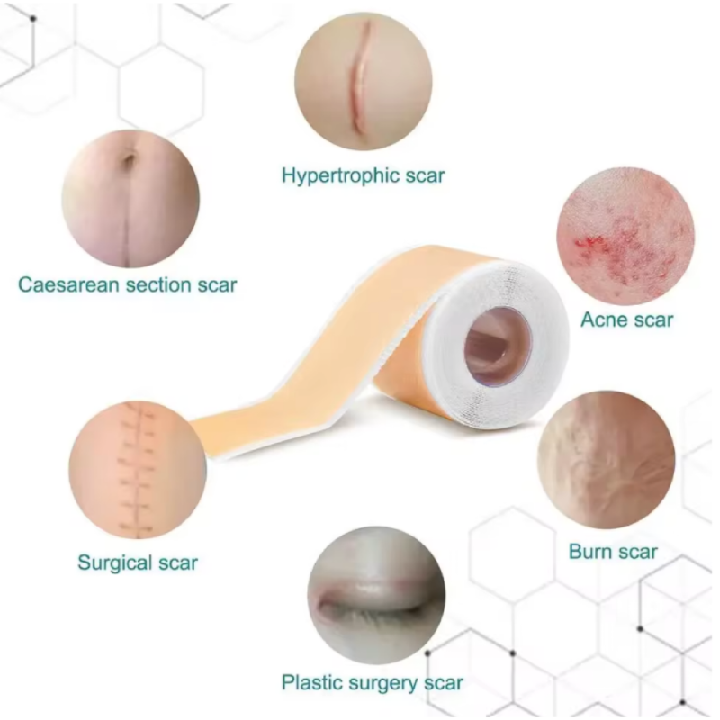 4cmx150cm Silicone Scar Sheets Removal Strips Silicone Gel Scar Strip For Acne Keloid Surgery Burn Treatment Scar Patch Hot Sale