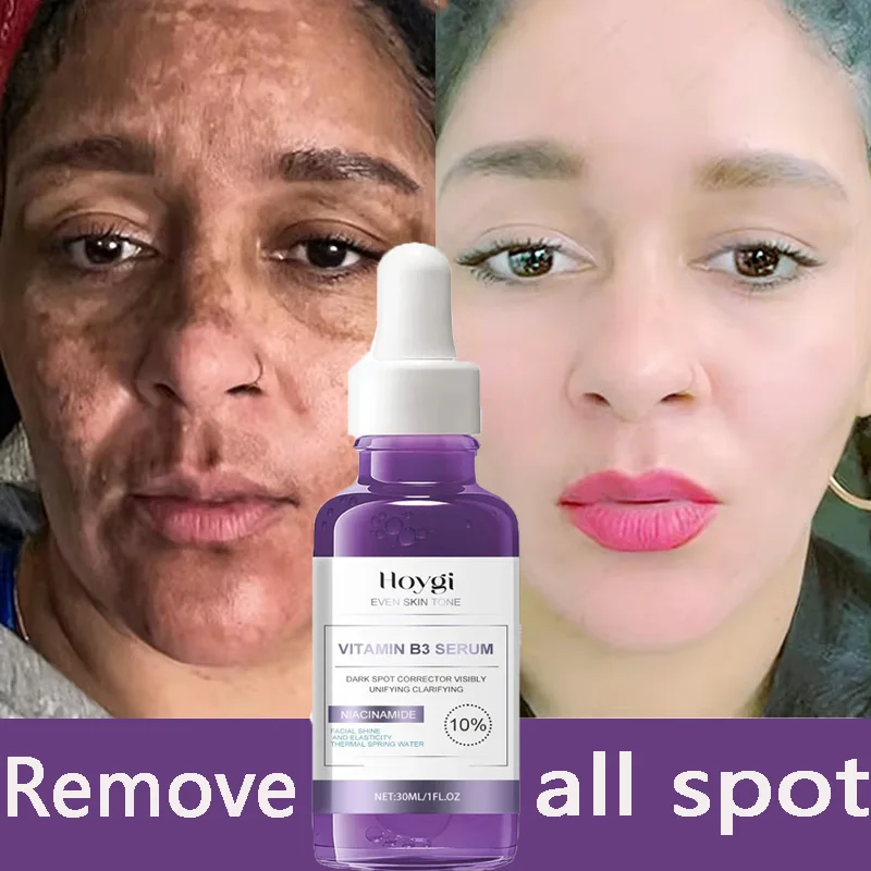 Potente eliminador de manchas oscuras, suero blanqueador de pecas, corrección de melanina, antipigmentación, ilumina el cuidado Facial coreano de día y noche