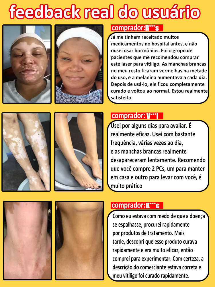 vitiligo laser