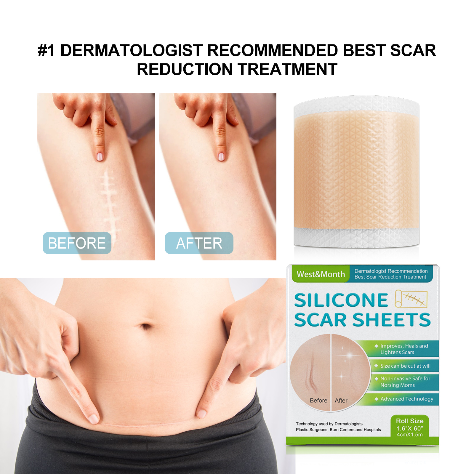 West เดือนซิลิโคนแผ่นแผลเป็นไม่เจ็บปวดที่มีประสิทธิภาพกันน้ํา Sweatproof Breathable สติกเกอร์ความงาม Skin Care แต่งหน้าความงาม