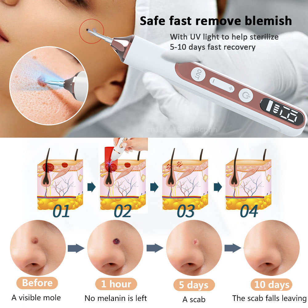 プラズマペンスキンタグリムーバーほくろ除去いぼスポットダークDpotブラックドット母斑そばかすフラット傷にきび除去顔ボディ用