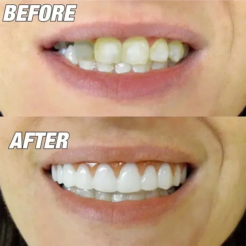 Cómodos dientes postizos sonrientes con relleno de pegamento para dientes, carillas superiores e inferiores desechables, maquillaje de dientes, diente falso temporal