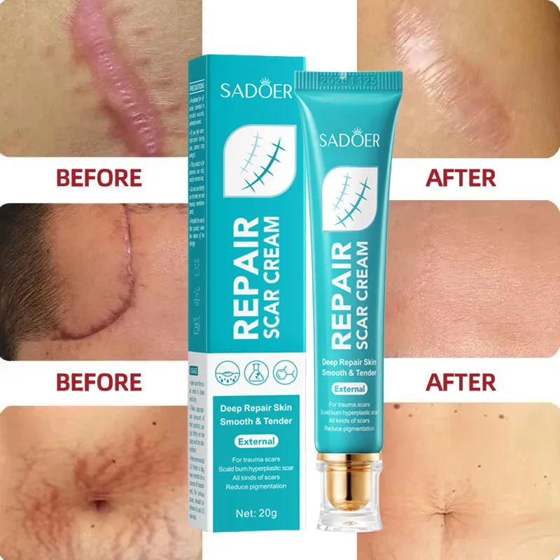 Crema para eliminar cicatrices, reparación de estrías, quemaduras de acné, ungüento quirúrgico para cicatrices de acné, tratamiento a base de hierbas, Gel blanqueador, belleza, cuidado de la salud