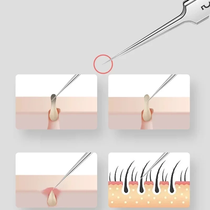 German Ultra-fine No. 5 Cell Pimples Blackhead Clip Tweezers Beauty Salon Special Scraping & Closing Artifact Acne Needle Tool