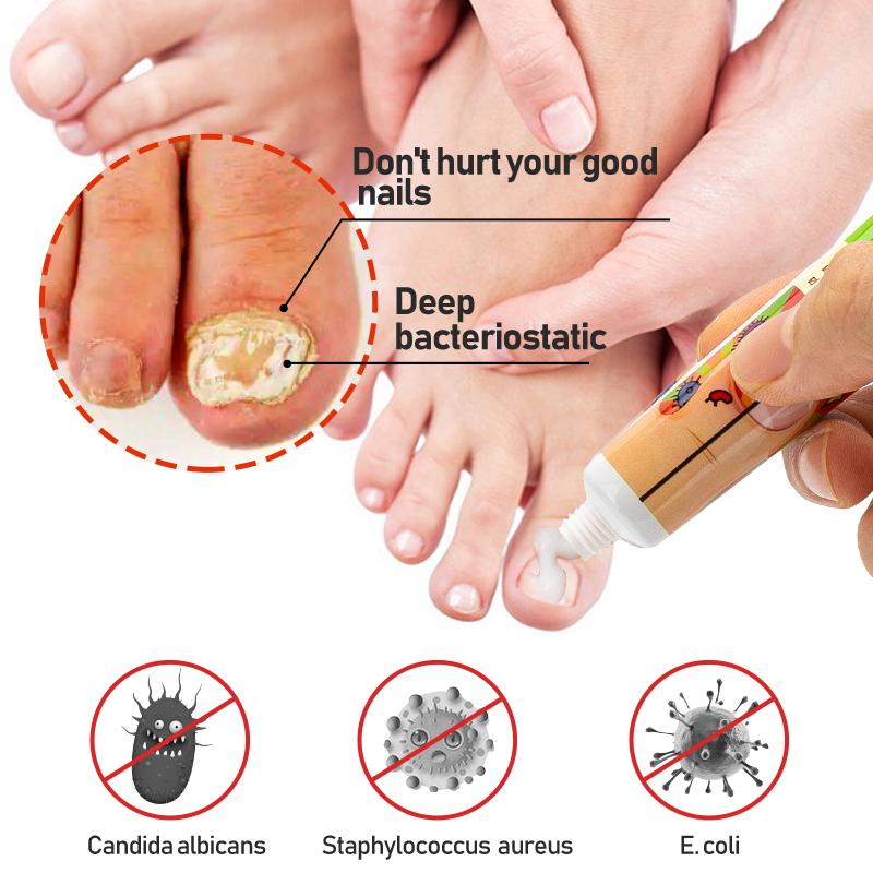 1pcs Nail Anti-fungal Cream Long-acting Bacteriostasis Fungal Nail Cream Strong Nails Ointment Nail Discolour Nail Peeling G004