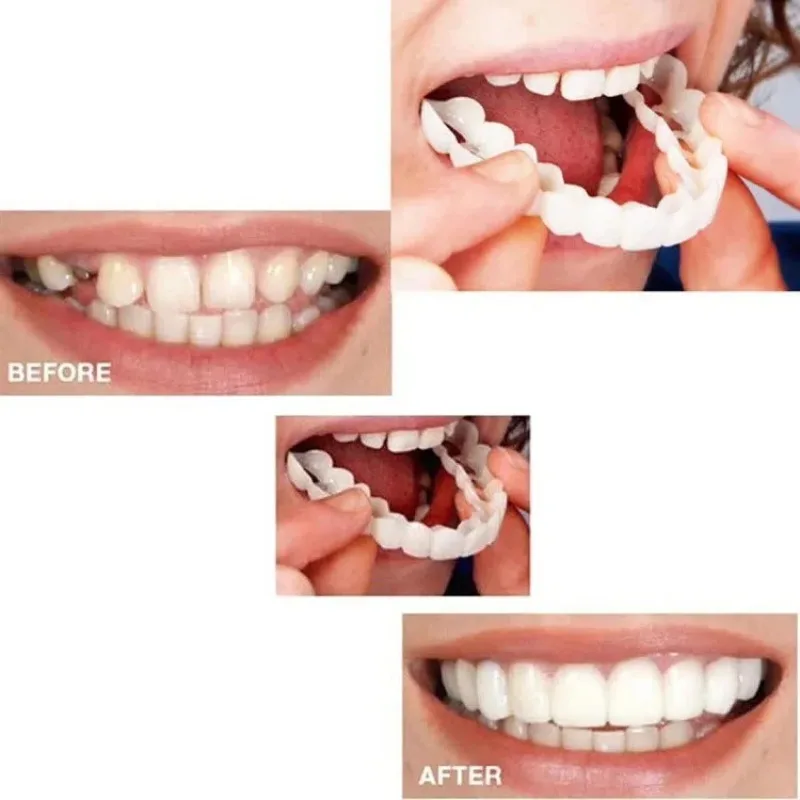Simulação dentadura superior/inferior conjunto de dentes com caixa aparelho ortodôntico silicone clareamento dos dentes capa chaves