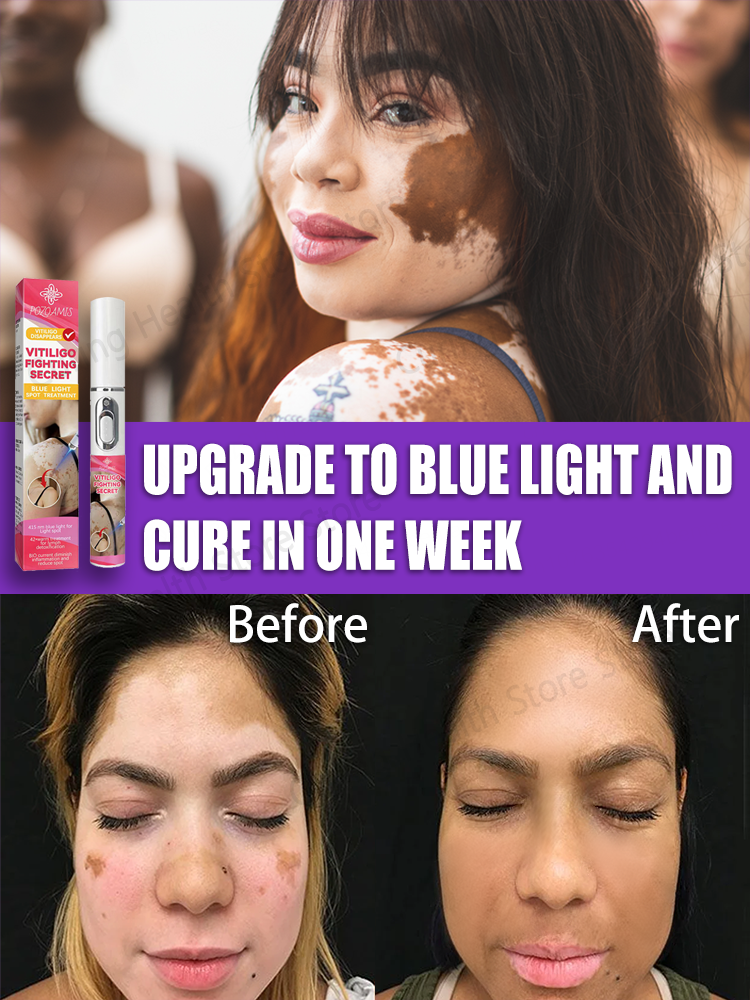 лазерный витилиго