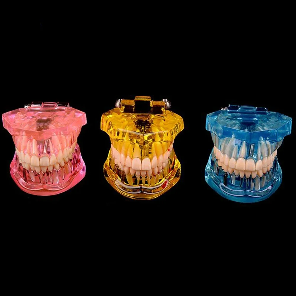 Modelos dentales Modelos de resina reparables de dientes enfermos para enseñar y investigaciones en medicina y enfermedades dentales