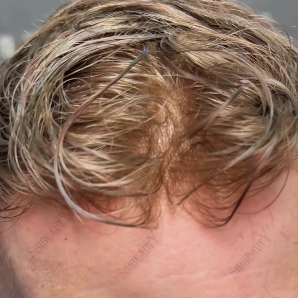 Prótesis de Cabello Humano para Hombre, Sistema de Reemplazo Capilar Transparente de PU, Base Micro Skin Vloop de 0.02mm, el Más Delgado, Rubio Gris