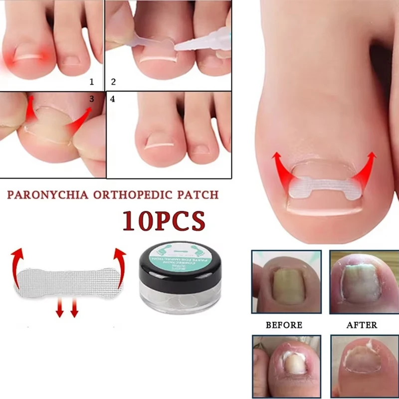 10 sztuk wrastający palec u nogi leczenie wrastający paznokieć narzędzie do korekcji elastyczna łatka naklejka klips do prostowania Brace narzędzia do Pedicure