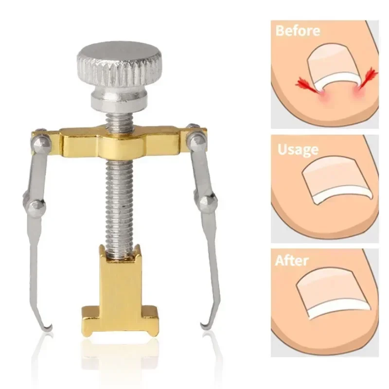 Corrector de uñas encarnadas, Clip alisador, herramientas para el cuidado de las uñas del pie, tratamiento de pedicura de acero inoxidable, corrección de ónixis