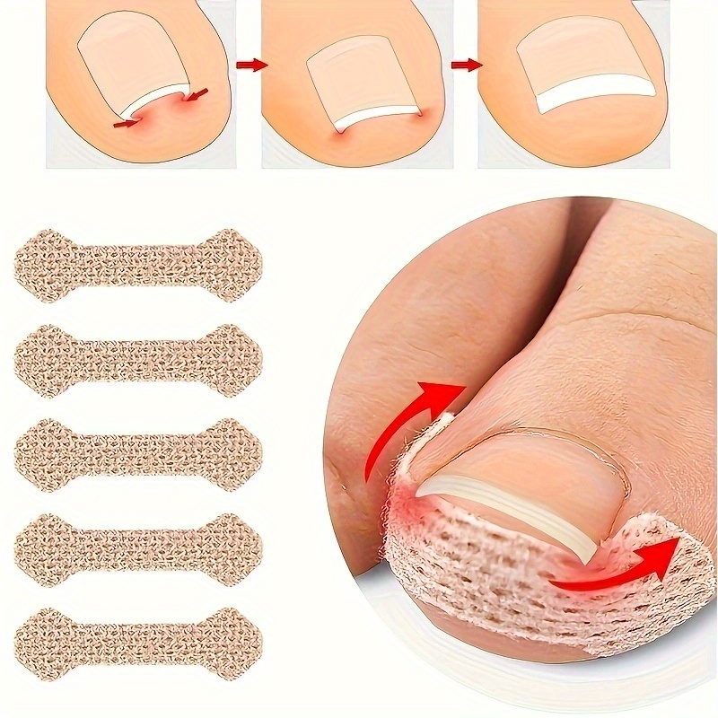 คุด Paronychia Toenail Corrector แถบ Anti F 10pcs คุด Paronychia Toenail Corrector แถบ Anti F