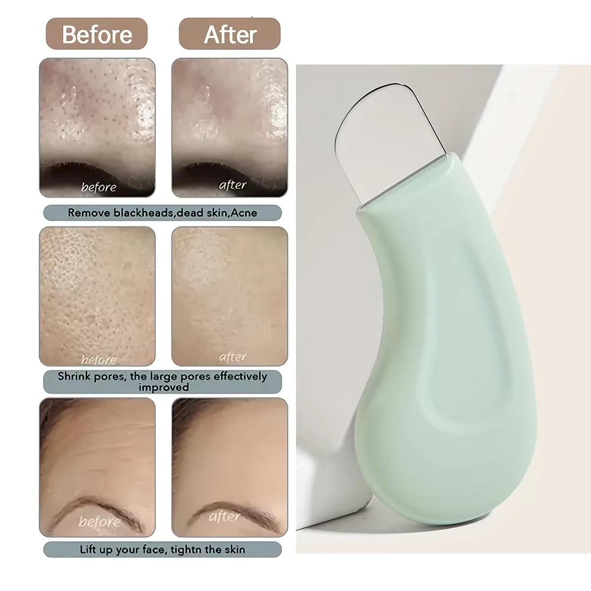 Herramienta para Eliminar Puntos Negros y Blancos de la Nariz y el Rostro, Limpiador de Poros de la Piel, No Daña la Piel, Herramientas de Cuidado de la Piel para Mujeres