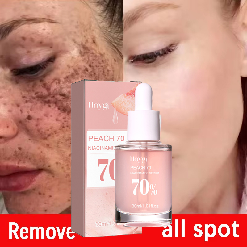 Niacinamida blanqueamiento pecas suero eliminación Melasma manchas oscuras aclara la melanina pigmentación brillo cuidado de belleza antienvejecimiento