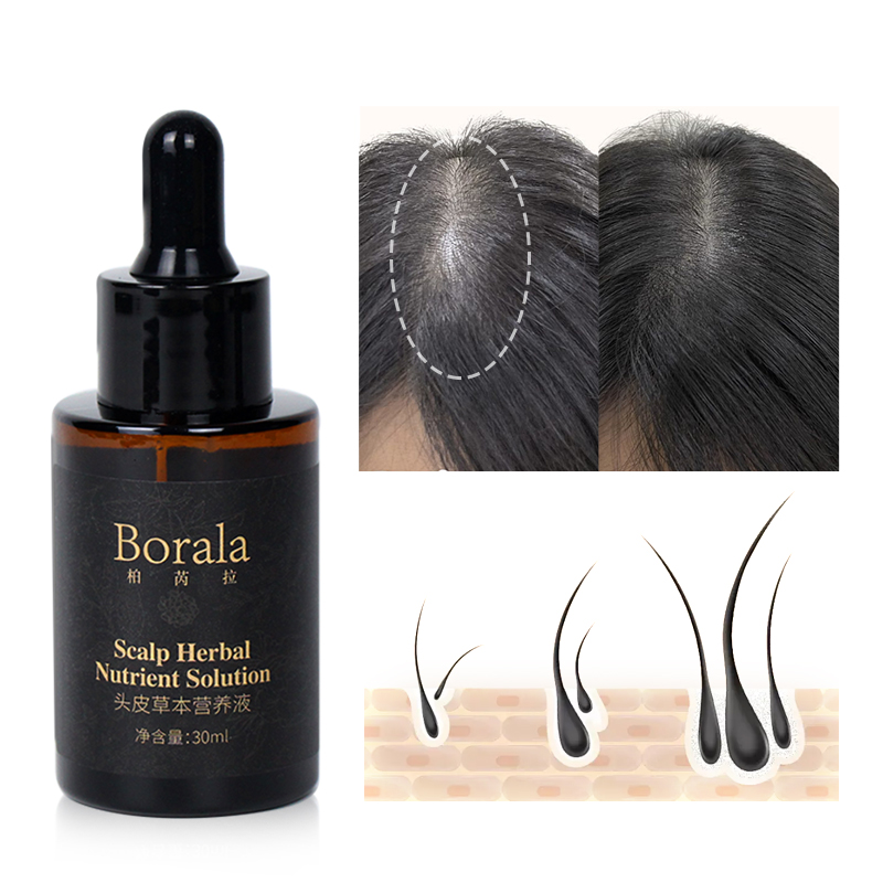 Kit de Sérum para Crescimento Capilar, Tratamento Anti-Queda de Cabelo, Previne Calvície, Fortalece Raízes, Essência de Cuidado do Couro Cabeludo de Rápida Absorção e Não Oleosa