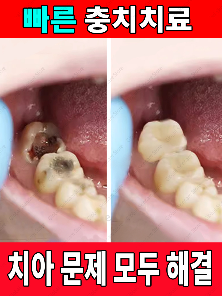 치아 부식 수리