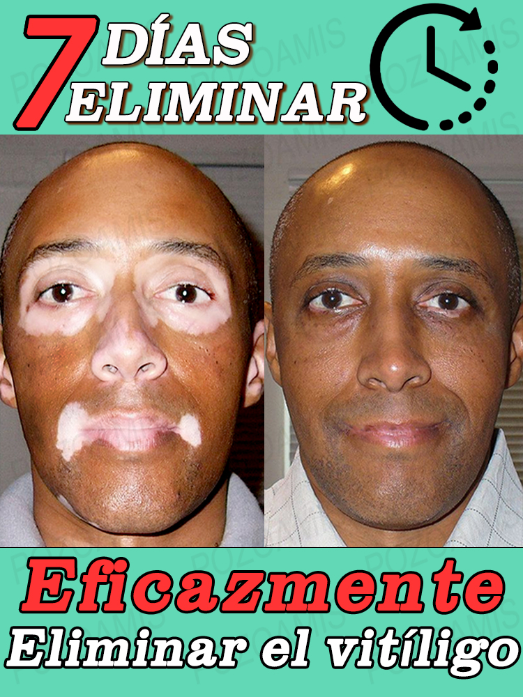 Crema para el tratamiento del vitíligo que mejora la pigmentación de la piel y reduce las manchas blancas. Ya no hay rastros de vitíligo. La esencia de extracto de planta ha salvado mi piel del peligro.
